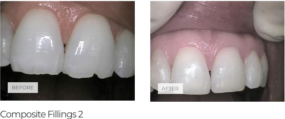 murrieta_cosmetic_dentistry_composite_fillings
