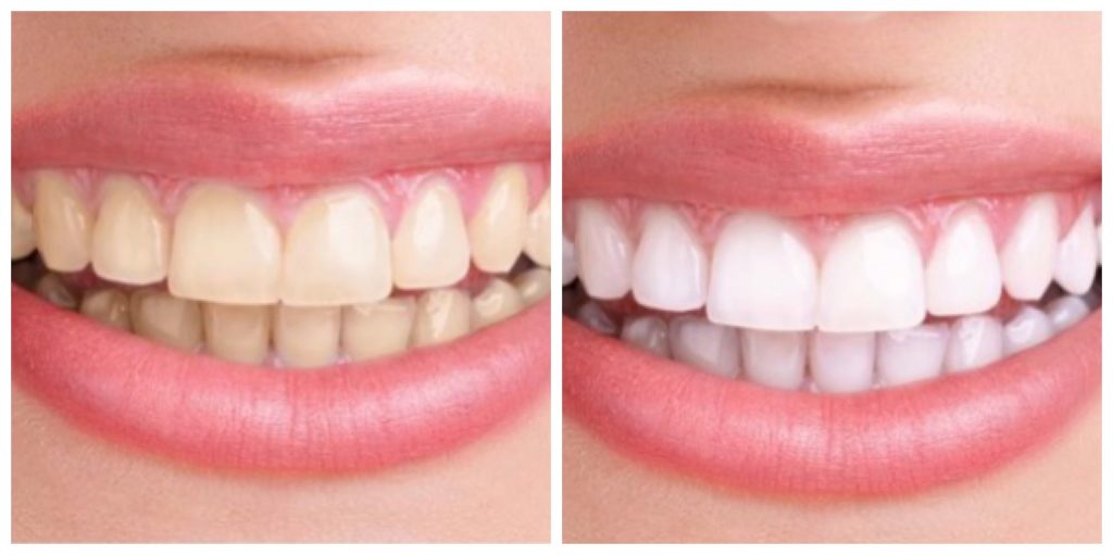 murrieta cosmetic dentistry teeth whitening before and after