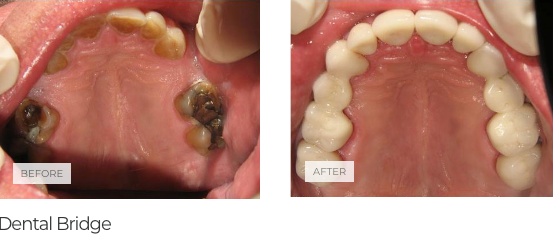 murrieta-cosmetic-dentistry-dental-bridge