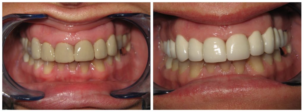 murrieta-dentist-dental-crowns-before-after